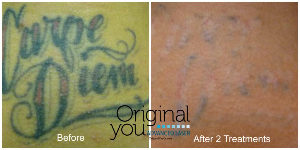 Laser tattoo removal before and after 2 treatments at Original You