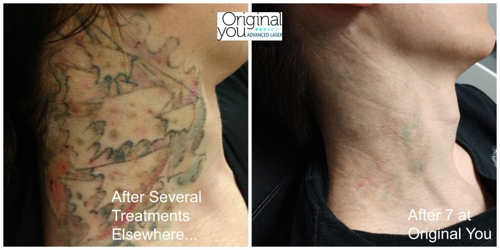 Laser tattoo removal before and after progress example from Original You