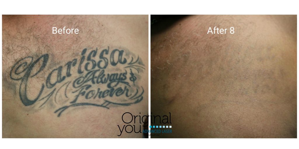 Name tattoo laser removal before and after 8 treatments at Original You