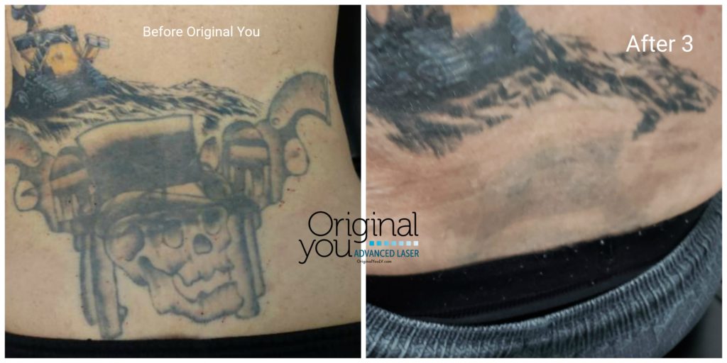 Selective laser tattoo removal on a back tattoo before and after 3 treatments