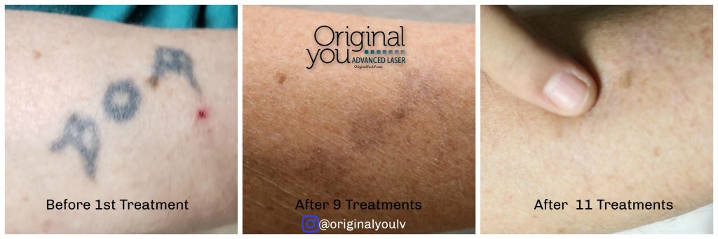 Laser tattoo removal progression showing before, after 8 treatments, and after 11 treatments