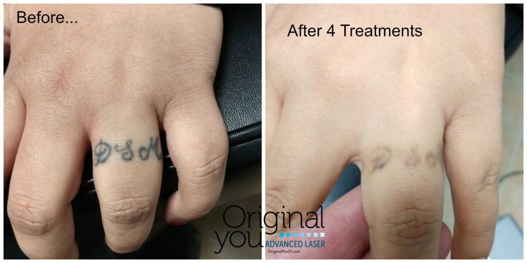 Ring finger tattoo removal before and after 4 treatments at Original You